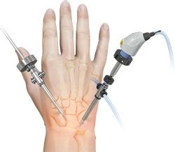 Wrist Arthroscopy Chandler, AZ | Casa Grande | Hip Fracture Mesa, Queen Creek