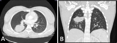 Figure 2 from Pulmonary abscess due to Streptococcus intermedius in ...