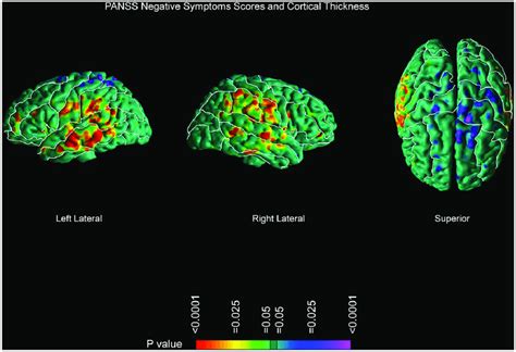 Correlations of Cortical Thickness with Severity of Negative Symptoms.... | Download Scientific ...