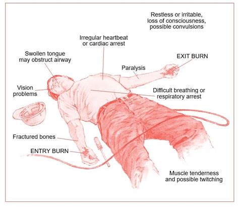 Types of electrical injuries