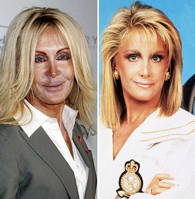 Joan Van Ark Plastic Surgery Before and After Nose Job, Facelift and Cheek Implants | Plastic ...