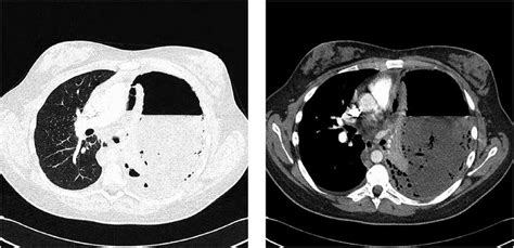 CT thorax on day of admission showing a left tension hydropneumothorax... | Download Scientific ...