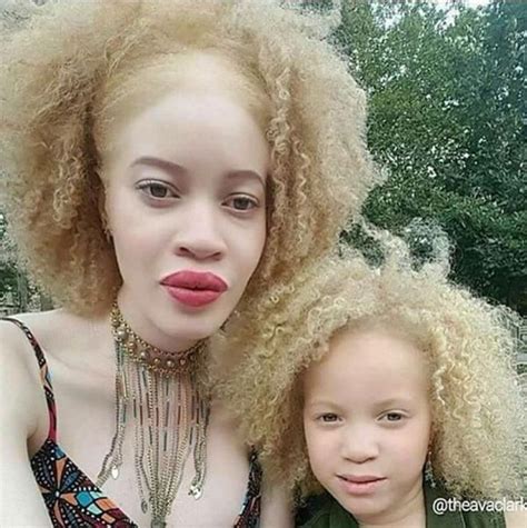 Albinism is a congenital disorder that removes pigment from the skin, hair and eyes. It occurs ...