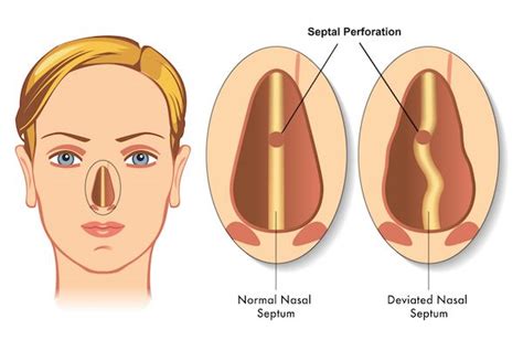 nose - SEPTAL PERFORATION - Dr. Meenesh Juvekar - ENT Specialist