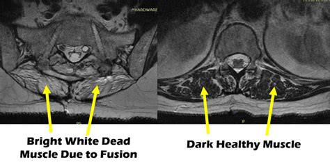 Is Pain After Spinal Fusion Normal? All You Need To Know