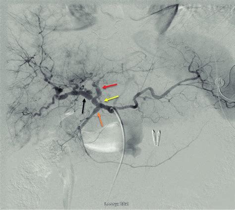 Digital substraction angiography of celiac trunk demonstarting diffuse... | Download Scientific ...