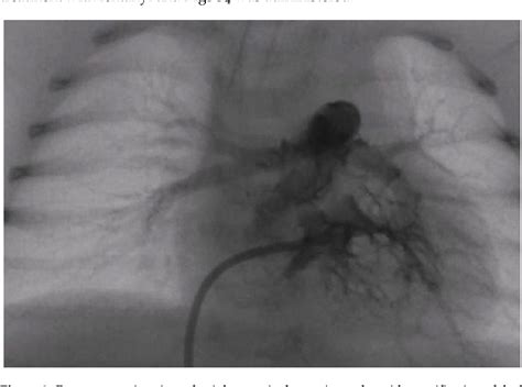 Figure 2 from Percutaneous Modified Blalock–Taussig Shunt Closure in a ...