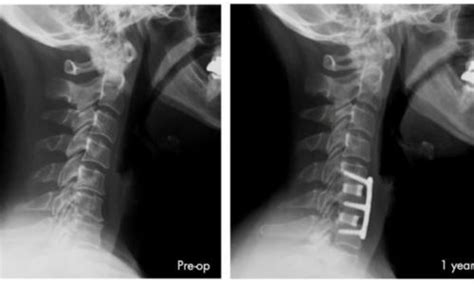 Alternatives To ACDF Surgery - Centeno-Schultz Clinic