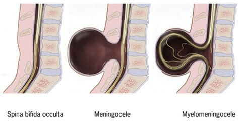 What is Spina Bifida? Causes, Symptoms, Diagnoses, and Treatment - Home ...