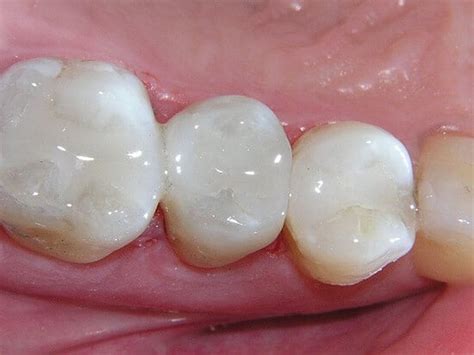 Cavity Fillings: The Difference Between White Fillings & Silver Fillings