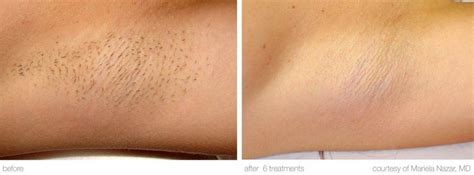 Laser Hair Removal in Los Angeles, CA | Beach Cities Vein