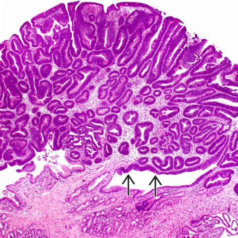 Ampullary Adenoma | Basicmedical Key