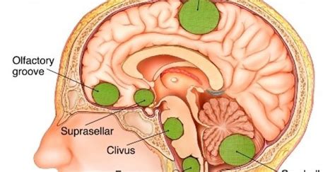 Meningiomas - Brain-Surgery.com