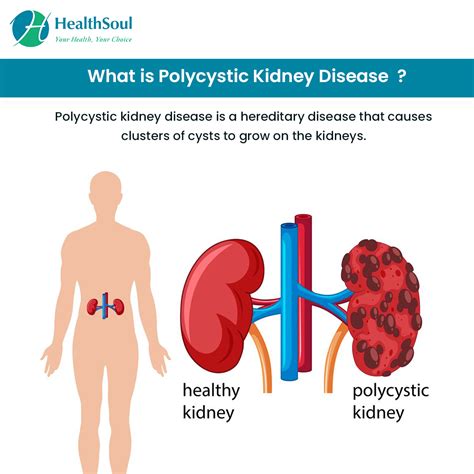 Polycystic Kidney Disease: Symptoms, Diagnosis, and Treatment – Healthsoul