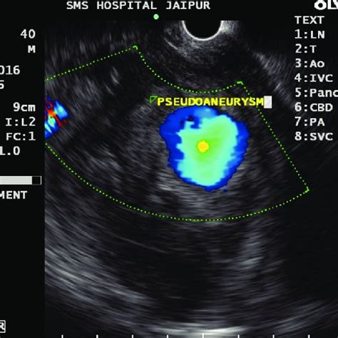 Endoscopic ultrasound shows pseudoaneurysm of gastroduodenal artery ...