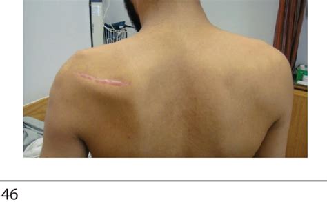 Suprascapular Nerve Entrapment Secondary to Compression at Suprascapular Notch: A Case Report ...