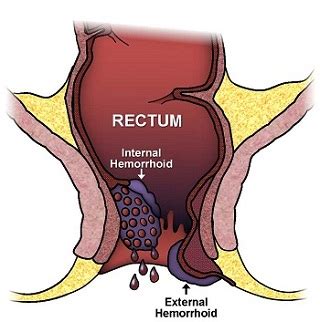 Signs and Symptoms of PILES (Hemorrhoids) | Mulvyadh