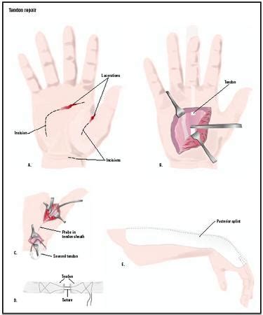 Tendon Repair - procedure, recovery, blood, pain, complications, adults, time, infection