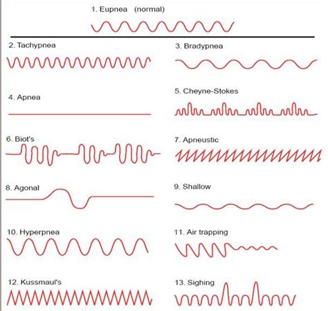 biot's respiration - Google Search | Nurse study notes, Respiratory ...