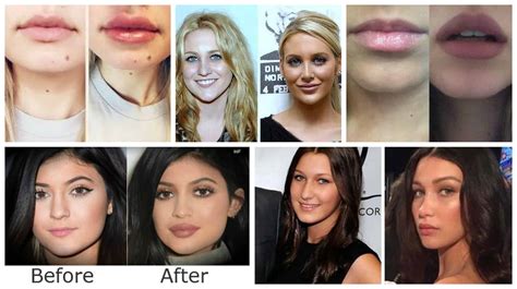 LIP Fillers & Why Is Everyone Getting Them?! | The Fashion Tag Blog