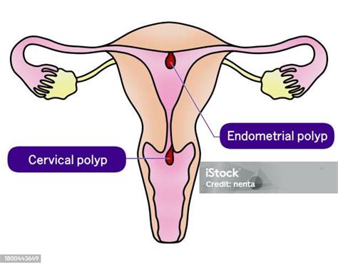 Illustration Of Endometrial Polyp And Cervical Polyp Stock Illustration - Download Image Now ...