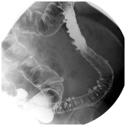 Double contrast barium enema (overview) | Radiology Reference Article | Radiopaedia.org