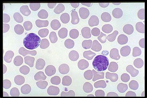 Leukemia, T-Cell; Leukemia, Lymphocytic, T-Cell; Lymphocytic Leukemia ...