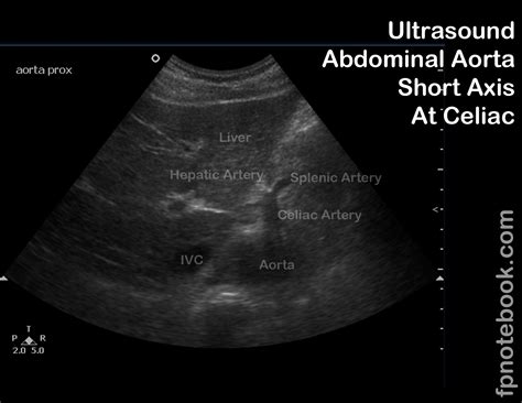 Abdominal Ultrasound Abdominal Aorta The Largest Artery In The Images | Images and Photos finder