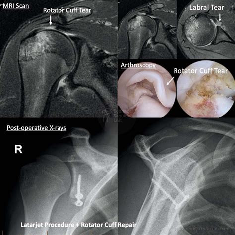 Labral Tears | Dr Pant - Sydney Shoulder Unit