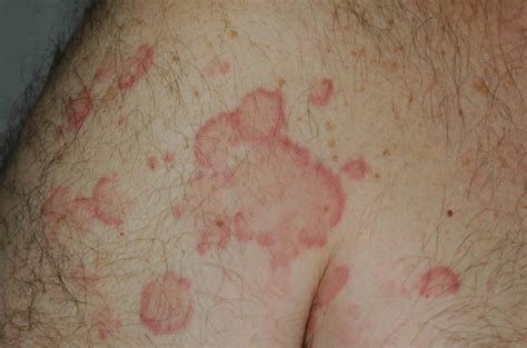 Urticarial Vasculitis - Types, Causes, Symptoms, Treatment