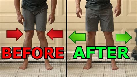 5 Ways To Fix Knocked Knees | Tight Inner Thighs - YouTube