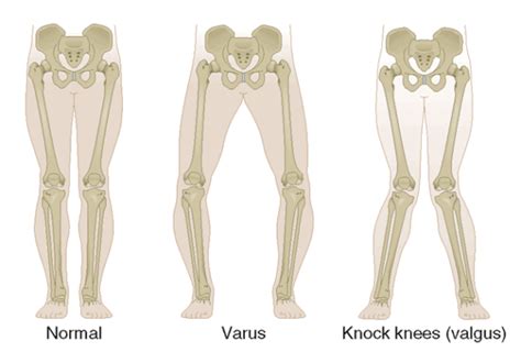 Can You Treat a Valgus Knee with Severe Arthirtis Without Surgery ...