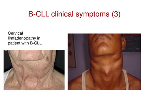 PPT - The Chronic Lymphocytic Leukemia (CLL) PowerPoint Presentation, free download - ID:3275647