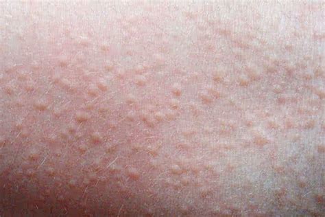 Heat Rash: Causes, Symptoms, Treatment and Prevention