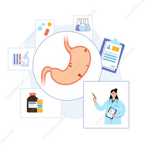 Stomach polyp removal, illustration - Stock Image - F036/5561 - Science Photo Library