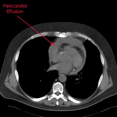 Pericardial Window Techniques; Pericardiostomy