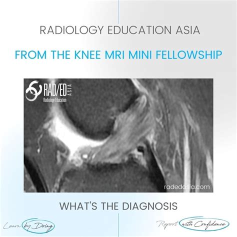 ACL MUCOID DEGENERATION RADIOLOGY MRI - Radedasia