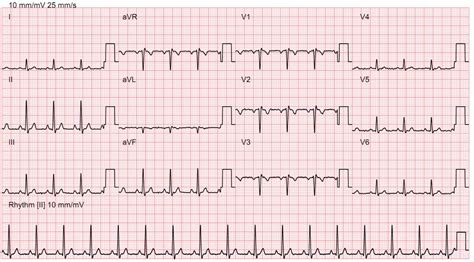 Electrocardiogram (ECG) – Bayside Medical Group