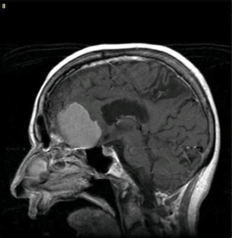 Medical School • CT scan showing brain tumor. (via diagnostics)