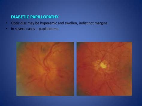 Optic disc evaluation