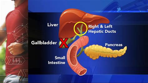 Moves in Medicine: What is Gallbladder attack - Gallstones surgery, treatment