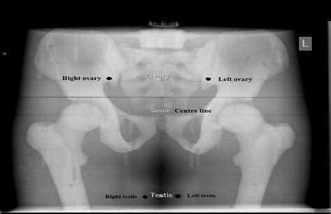 Can the anode heel effect be used to optimise radiation dose and image quality for AP pelvis ...