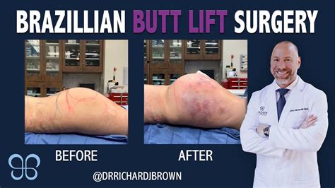 Brazilian Butt Lift Surgery and Pre-Op Example | Brown Plastic Surgery ...