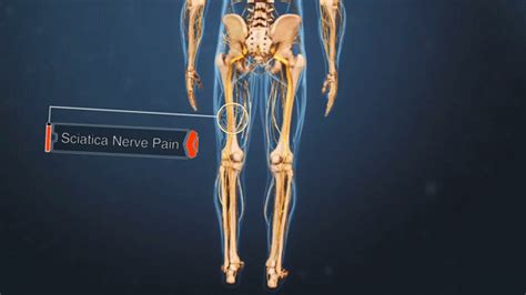 Pin on Back- Spine- Sciatica Pain