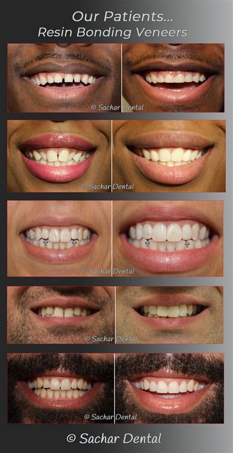 Resin Bonding Veneers NYC: Dr Sachar