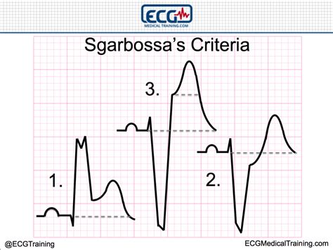 Chest Pain and Left Bundle Branch Block – Making Sense of Sgarbossa’s ...