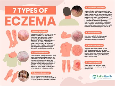 7 Types Of Eczema – NBKomputer