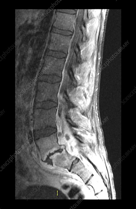 Epidural Abscess, MRI - Stock Image - C027/1899 - Science Photo Library