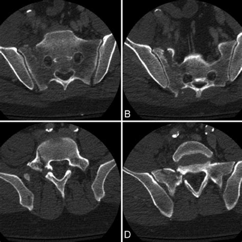 The Denis classification of sacral fractures. A: The 3 zones (Zone I ...