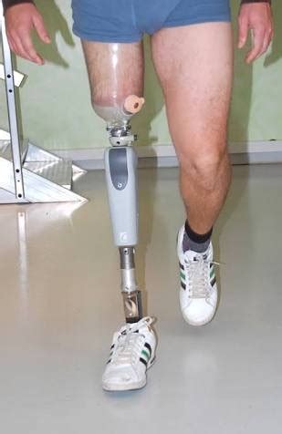 Computerized Above Knee Prosthesis/Leg, Artificial Limbs, कृत्रिम अंग - Deccan Orthopro Private ...